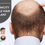 Jaipur SkinCity Affordable Hair Transplant in Jaipur: Dr. Sachin Sharda