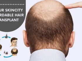 Jaipur SkinCity Affordable Hair Transplant in Jaipur: Dr. Sachin Sharda