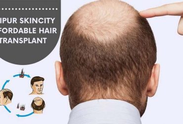 Jaipur SkinCity Affordable Hair Transplant in Jaipur: Dr. Sachin Sharda
