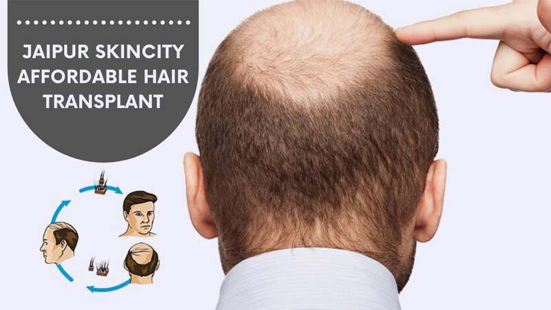 Jaipur SkinCity Affordable Hair Transplant in Jaipur: Dr. Sachin Sharda