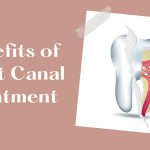 Benefits of Root Canal Treatment