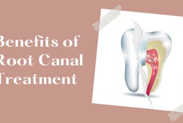 Benefits of Root Canal Treatment