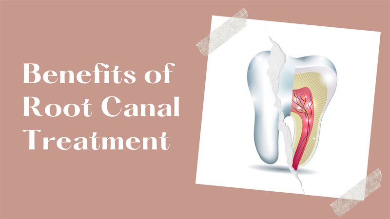 Benefits of Root Canal Treatment