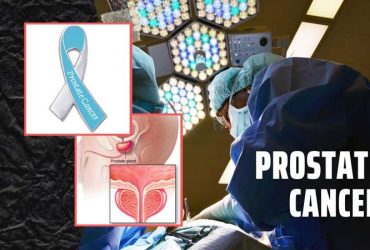 Prostate Cancer: Causes, Symptoms, Treatment, and Prevention