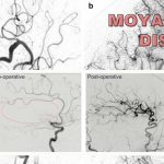 Moyamoya disease