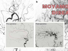 Moyamoya disease
