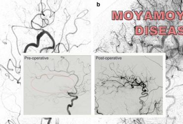 Moyamoya disease