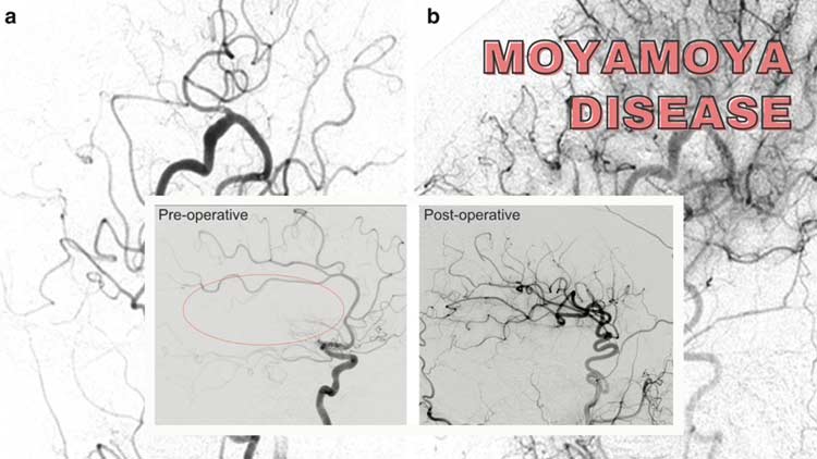 Moyamoya disease