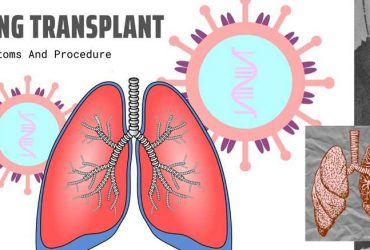 Lung Transplant: Symptoms And Procedure