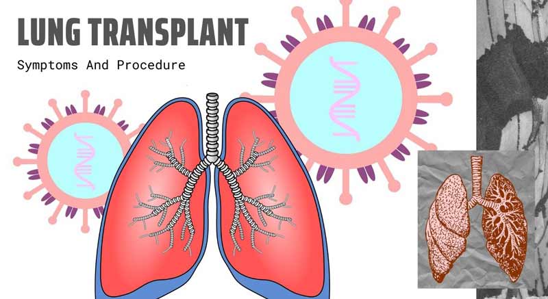 Lung Transplant: Symptoms And Procedure