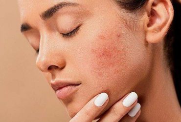How to Choose a Moisturizer for Oily Skin?
