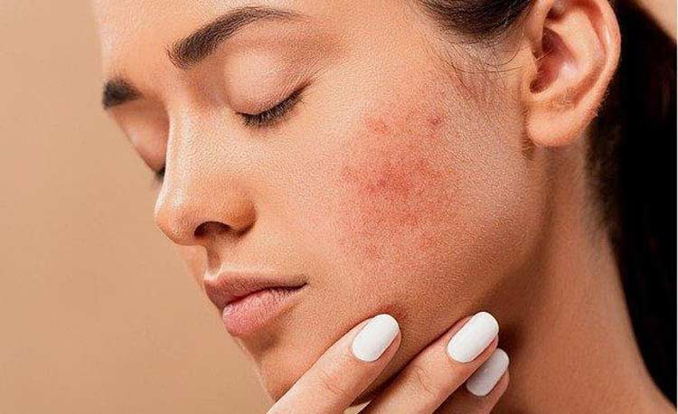 How to Choose a Moisturizer for Oily Skin?