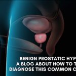 Benign prostatic hyperplasia: A blog about how to treat and diagnose this common condition