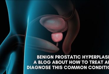 Benign prostatic hyperplasia: A blog about how to treat and diagnose this common condition