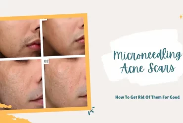 Microneedling Acne Scars How To Get Rid Of Them For Good