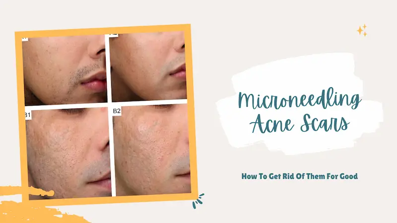 Microneedling Acne Scars How To Get Rid Of Them For Good