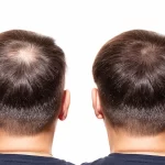 The Radical PRP Hair Loss Treatment: A Natural Solution For Thinning Hair