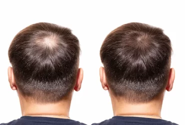 The Radical PRP Hair Loss Treatment: A Natural Solution For Thinning Hair