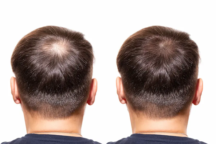 The Radical PRP Hair Loss Treatment: A Natural Solution For Thinning Hair
