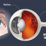 Retinal Detachment Causes, Symptoms, And Treatment