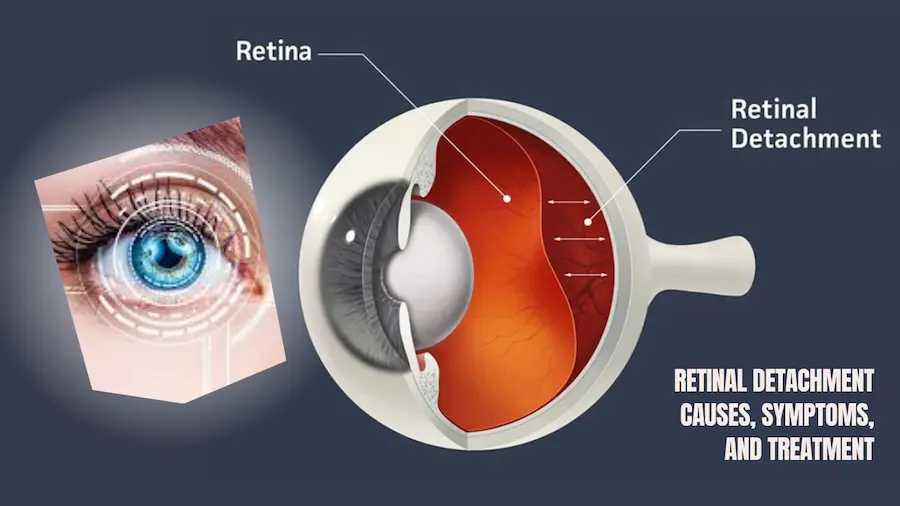 Retinal Detachment Causes, Symptoms, And Treatment