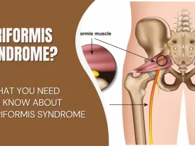 What You Need To Know About Piriformis Syndrome