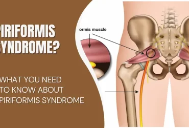 What You Need To Know About Piriformis Syndrome